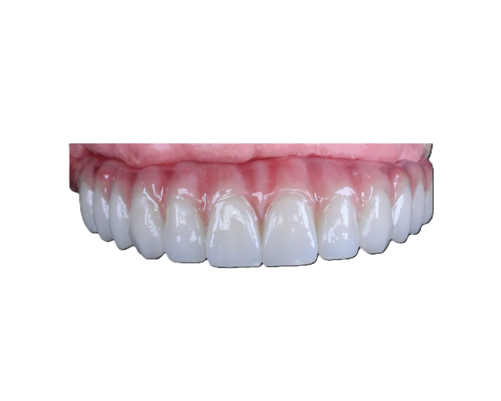 Lucrare Dentallx — ceramică stratificată nr. 5