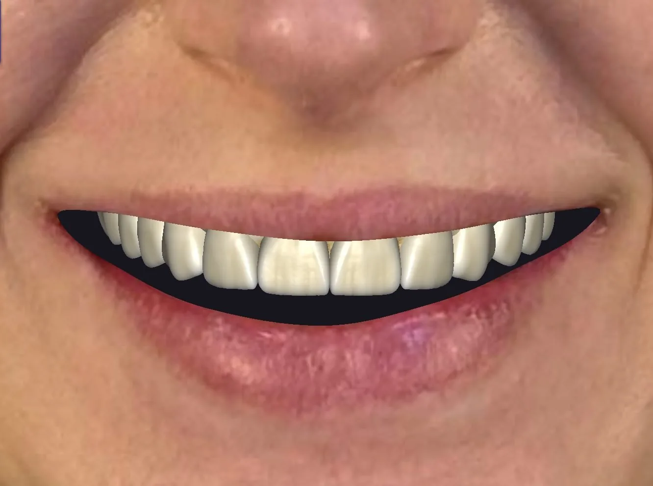 Digital Smile Design / Wax-up